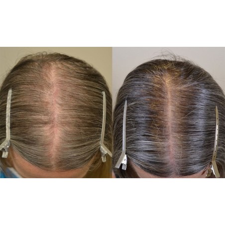 Spuma 2 Luni, Rogaine, Minoxidil, 5%, Tratament Impotriva Caderii Parului, pentru Femei, 1x 60ml