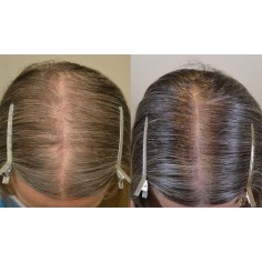 Spuma 4 Luni, Rogaine, Minoxidil, 5%, Tratament Impotriva Caderii Parului, pentru Femei, 2x 60ml 2