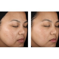 Gel, Menarini, A-Ret, Anti-Acne, Anti-Wrinkle, Tretinoin 0.1%, 20gr 2
